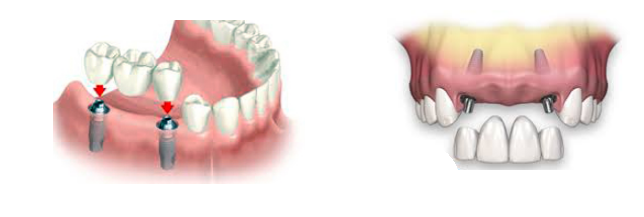 IMPLANTOLOGÍA 3.PNG