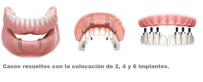 IMPLANTOLOGÍA 4.PNG